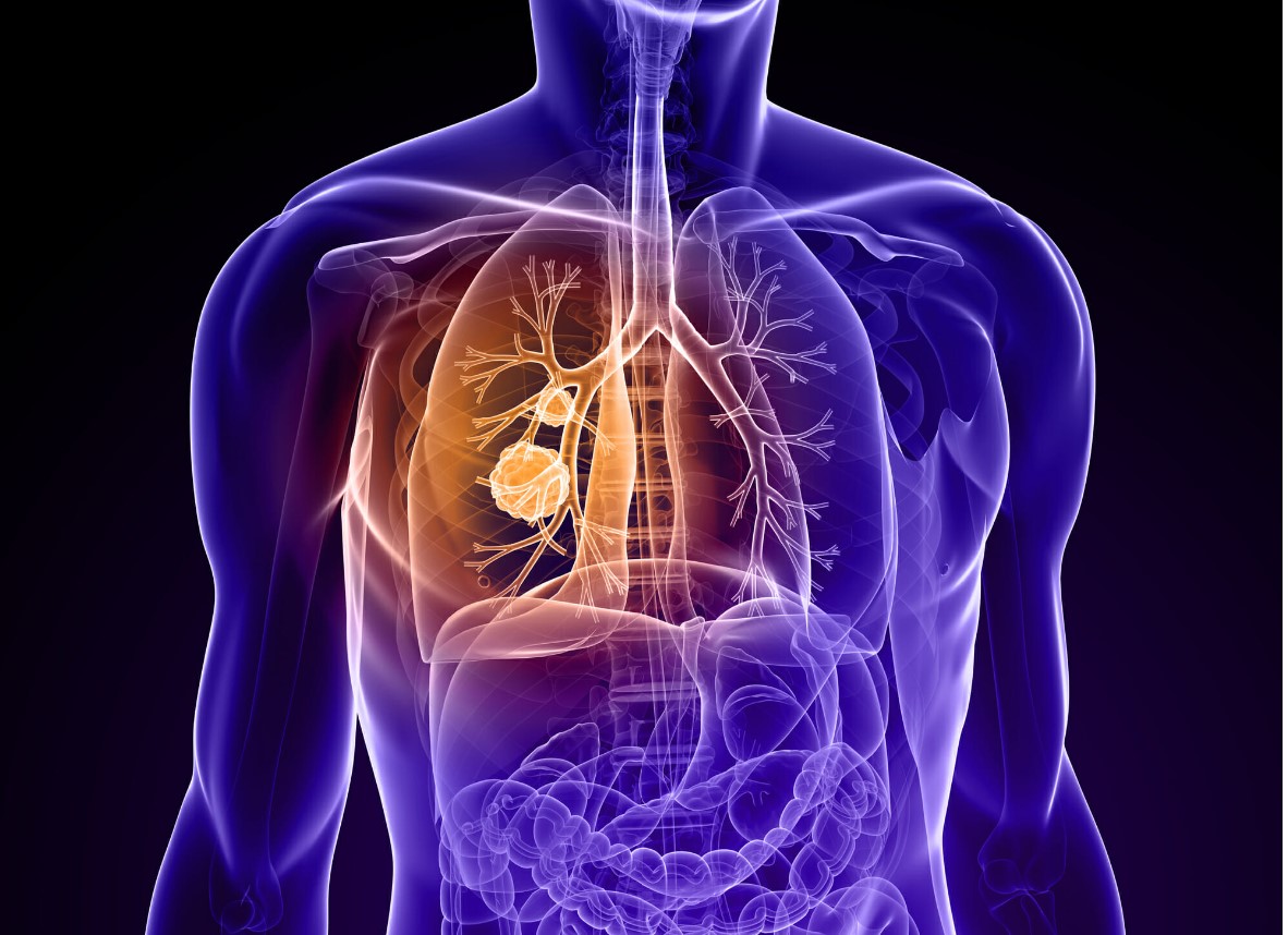 Primaire tumorresectie na EGFR-TKI geeft veelbelovende PFS bij gemetastaseerd NSCLC<i class='restricted-content fa fa-lock'></i>