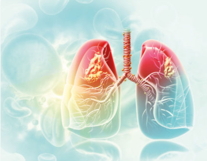 Serplulimab plus chemotherapie bij ES-SCLC<i class='restricted-content fa fa-lock'></i>