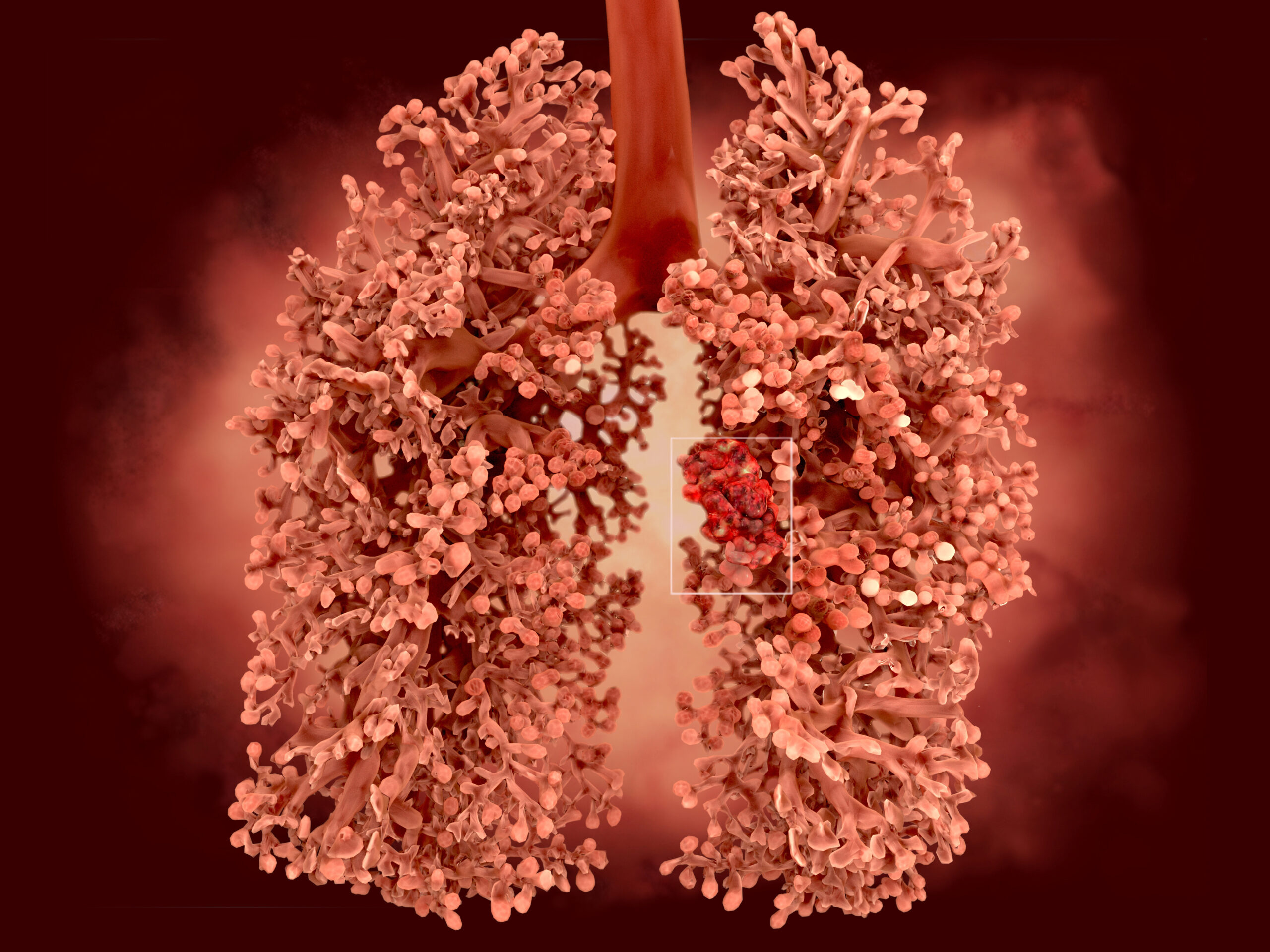 FDA breidt de indicatie van sevabertinib uit voor non-sq-NSCLC<i class='restricted-content fa fa-lock'></i>
